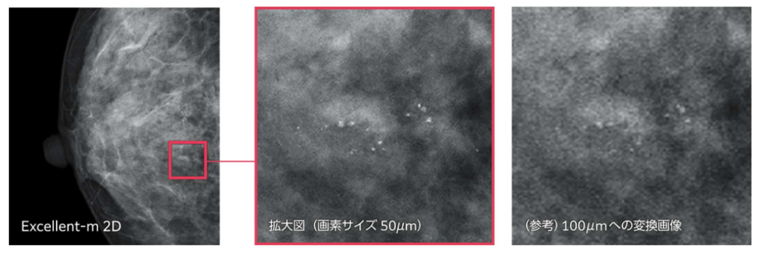 マンモグラフィ