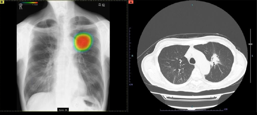胸部レントゲン用AI