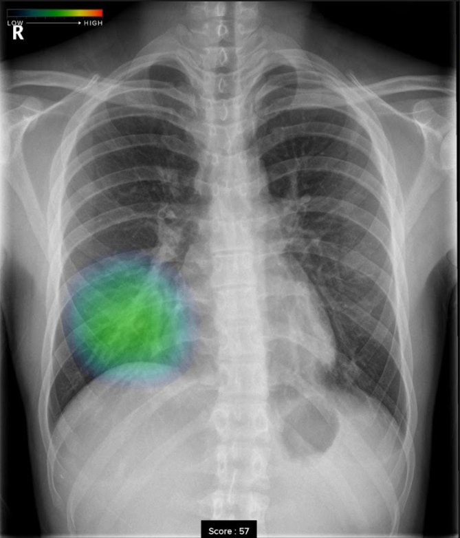胸部レントゲン用AI