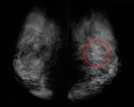 検診で発見された早期乳がん