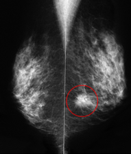 乳がんの典型的なマンモグラフィー